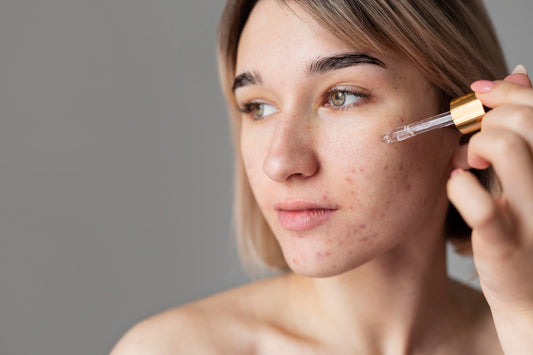 Come Rimuovere le Macchie Post Acne